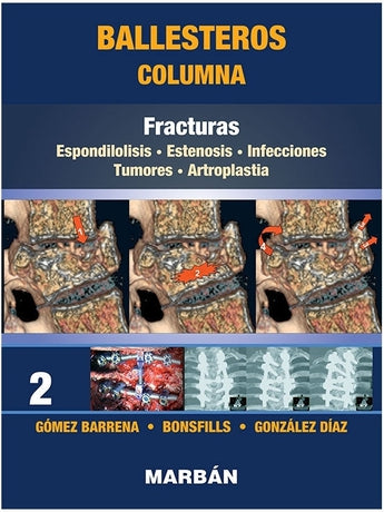 Columna Tomo 2: Fracturas