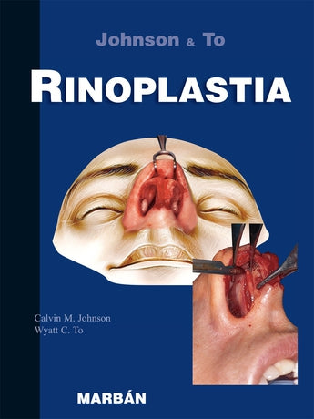 Rinoplastia